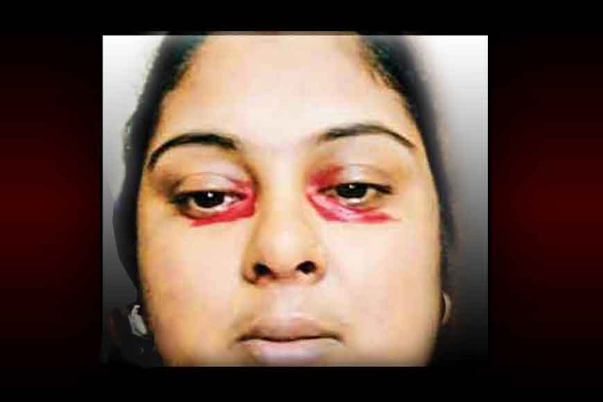 Kolkata&rsquo;s SSKM hospital saves a woman with blood tears!
